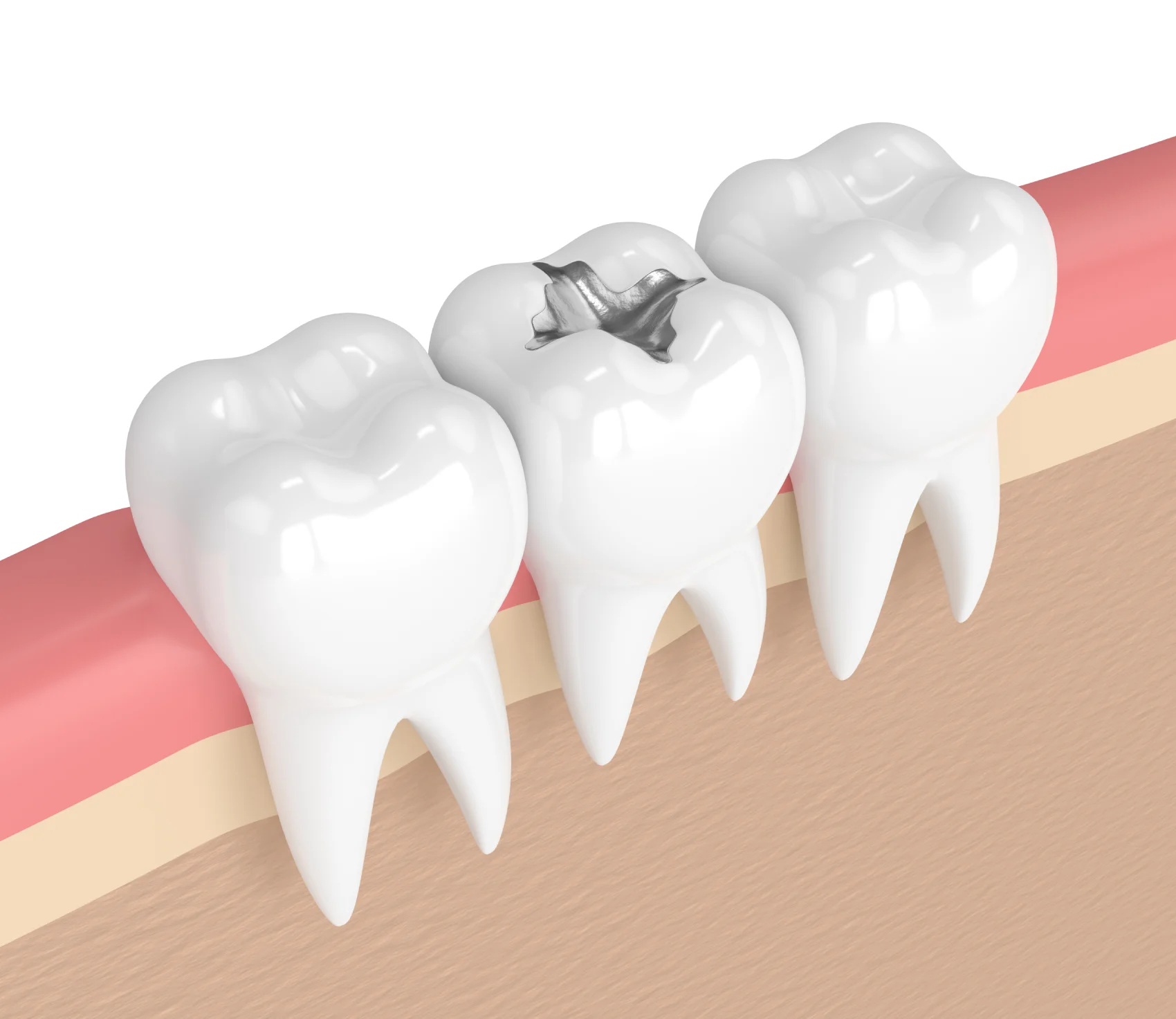 18. The Truth About Silver Fillings: What You Need to Know Before You Decide