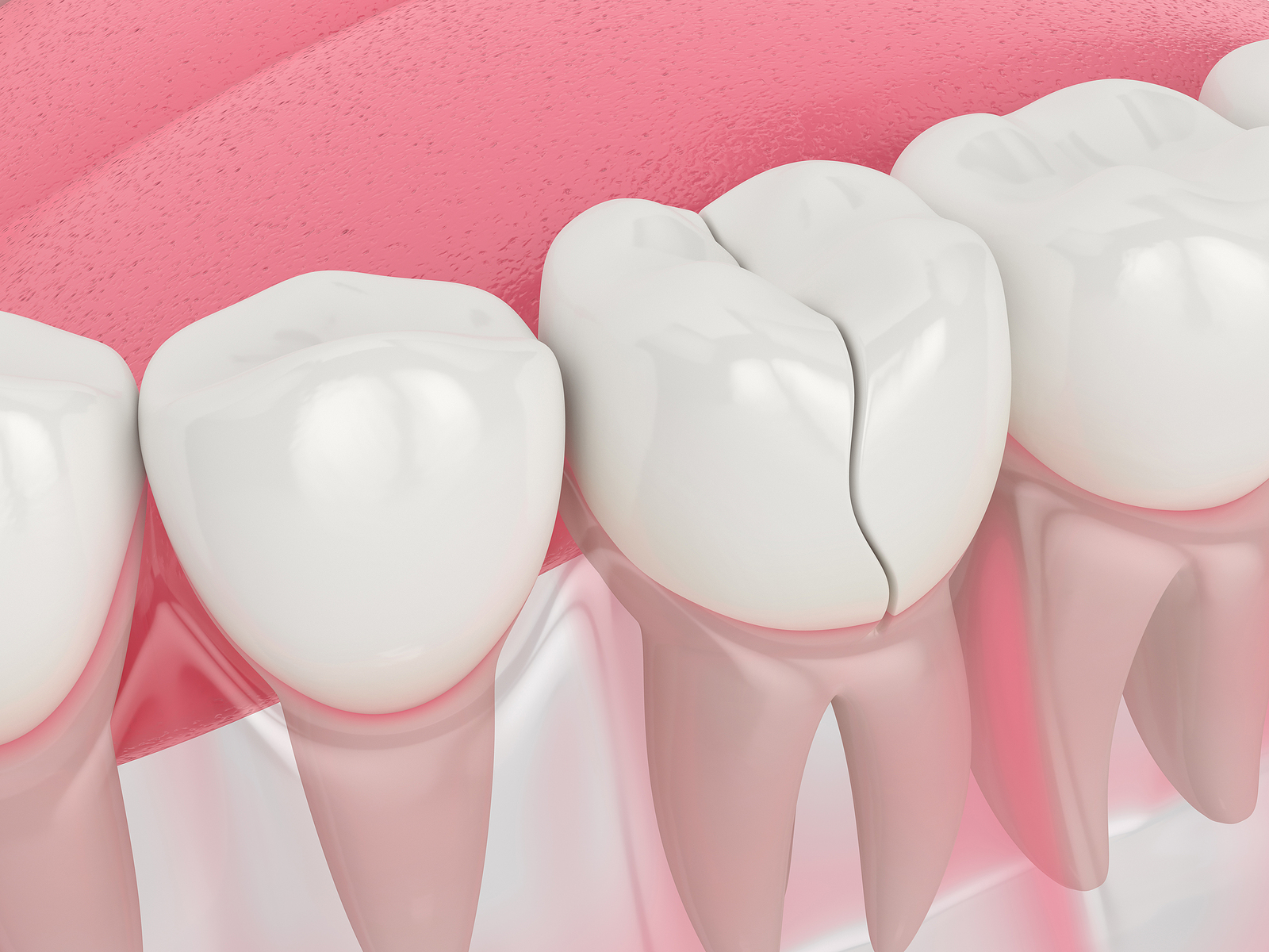 9. When a Cracked Tooth Means Trouble (and What You Can Do About It)